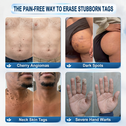 👩‍⚕️ 𝟕-𝐃𝒂𝘆 𝐒𝗸𝐢𝐧 𝐓𝒂𝗴 & 𝐒𝐩𝙤𝐭 𝐄𝐫𝒂𝐬𝙚𝐫 Painless & Scar-Free Advanced Imperfection Removal Rollerball Pen